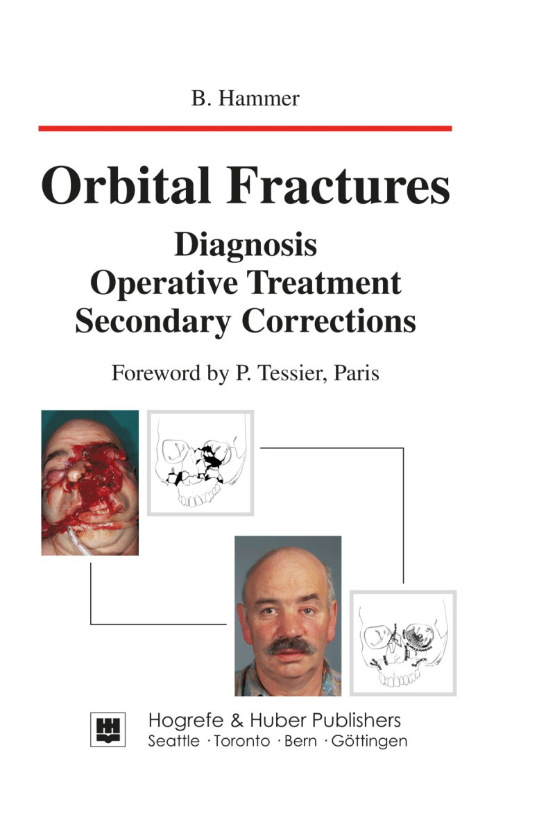 Orbital Fractures